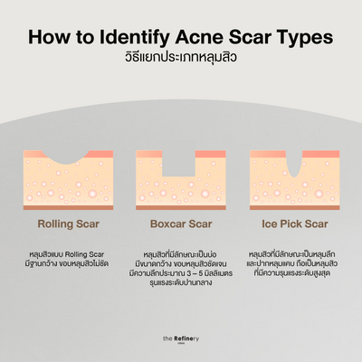 Acne Scar Refining<br><br>(โปรแกรมรักษาหลุมสิว)<br><br>