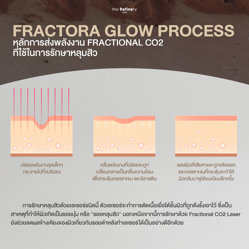 Fractora Glow<br><br>(Fractional CO2 Laser)<br><br>